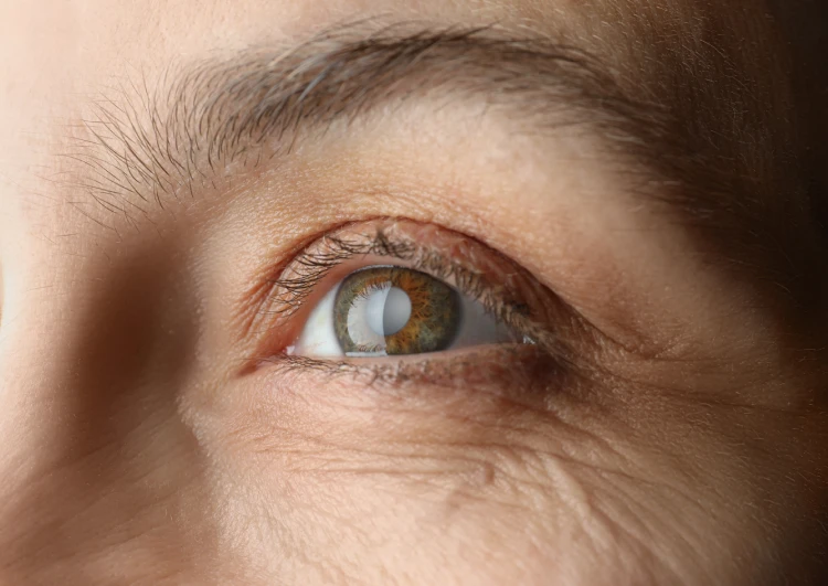 Monofocal Intraocular Lenses